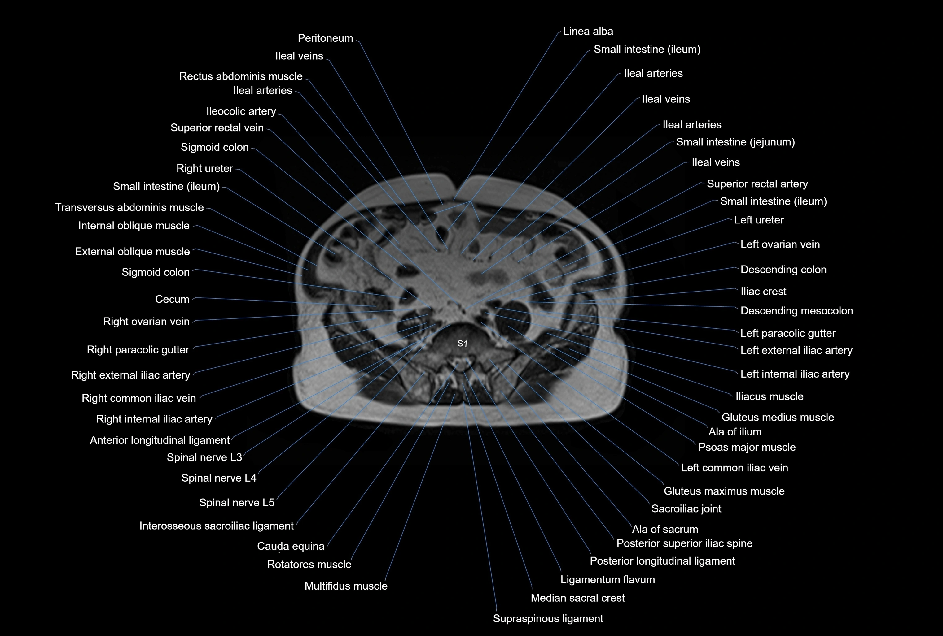 MRI Abdomen axial cross sectional anatomy radiology  image-img-00001-00039.webp